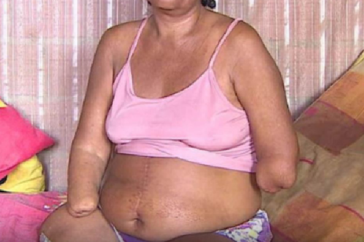 INSS Nega Benefício a Mulher com Mãos e Pernas Amputadas em Porto Velho