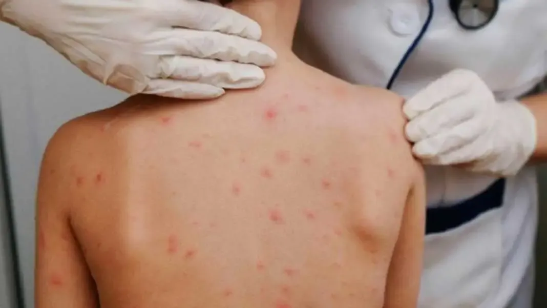 Surto de sarna em Balneário Camboriú: possível ligação com uso de ivermectina