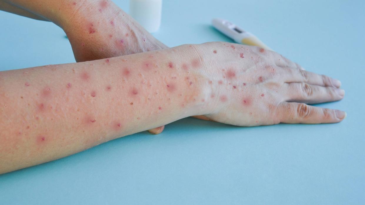 Organização Mundial da Saúde declara mpox como emergência em saúde pública global