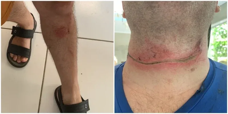 Motoboy sofre acidente após se enroscar em fio de telefone baixo em Osório.