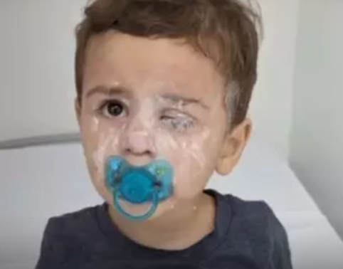 Criança de 1 ano cola o próprio olho com Super Bonder e é levada às pressas ao hospital