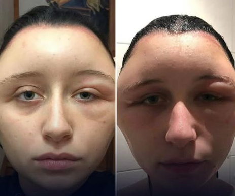 Jovem tem reação alérgica grave a tinta de cabelo e é internada em Paris