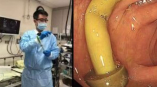 Médico encontra cogumelo intacto no intestino de paciente em Taiwan