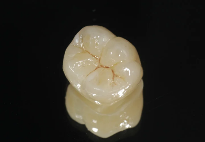 Implante dentário com sensibilidade real é criado nos EUA e pode aposentar próteses tradicionais