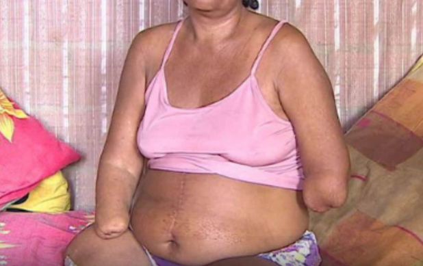 INSS Nega Benefício a Mulher com Mãos e Pernas Amputadas em Porto Velho