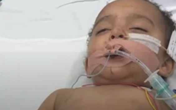 Pior pesadelo: Bebê de 1 ano e 8 meses sofre queimaduras gravíssimas ao ingerir desentupidor de ralo e tem parada cardíaca no hospital