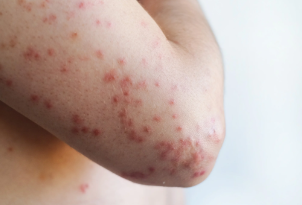 Casos de sarampo nas Américas aumentam 23 vezes e Opas emite alerta aos países