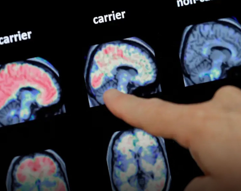 Estudo aponta que menopausa provoca alterações cerebrais semelhantes ao Alzheimer