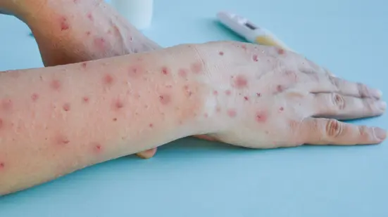 Brasil registra 140 casos confirmados de Mpox em 2026, segundo Ministério da Saúde