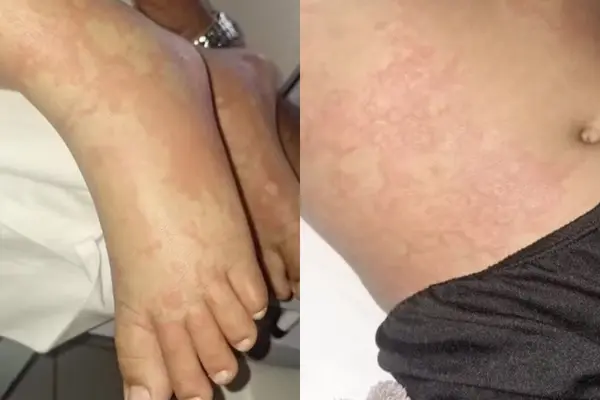 Menina de 10 anos é internada no RN após contato com detergente investigado pela Anvisa