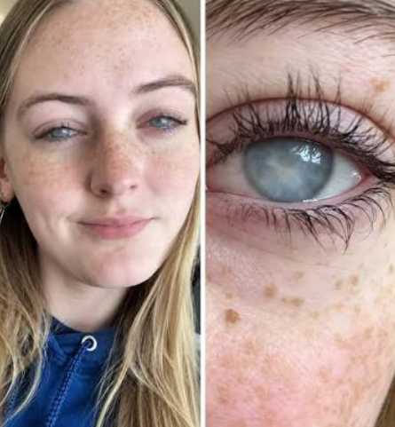 Jovem fica temporariamente c3g4 dos dois olhos após tomar banho usando lentes de contato