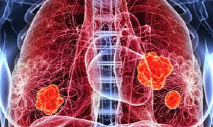 Hospital de Porto Alegre participa de teste internacional de vacina contra o câncer de pulmão