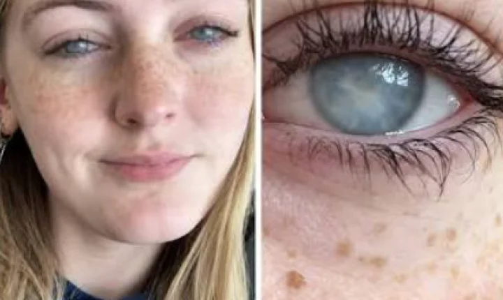 Jovem fica temporariamente c3g4 dos dois olhos após tomar banho usando lentes de contato