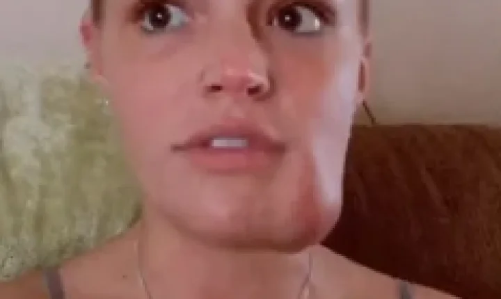 Mulher convive há 19 anos com tumor vascular no rosto e decide dar nome à protuberância